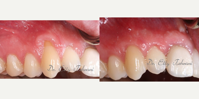 Gum recession on multiple teeth - Pinhole gum rejuvenation technique was used to cover the exposed roots and to correct receded gums.