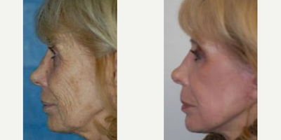 Woman treated with Mini Facelift - Woman treated with CO2 Laser Resurfacing and Mini Facelift.