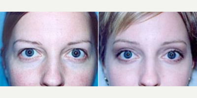 Woman treated with Eyelid Surgery - Woman treated with Eyelid Surgery