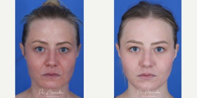 25-34 year old woman treated with ResurFX - Gender: female Ethnicity: Caucasian Procedure: ResurFX
