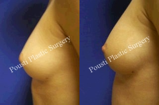 Nipple-Areola Repair - 	This 23 year old patient from San Diego California she is now 2 months post-op inverted nipple repair on both sides.