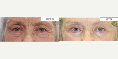 Woman treated with Eyelid Surgery, Brow Lift - Woman treated with Eyelid Surgery, Brow Lift