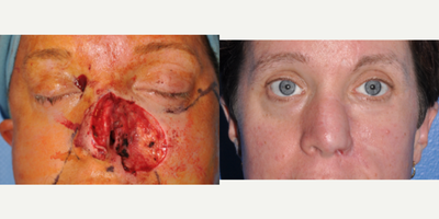 Nasal & Cheek Reconstruction with Forehead Flap & Cheek Local Flap Reconstruction after Mohs Surgery - This 36 year old woman had a defect that included her cheek and a full-thickness defect that encompassed the entire left half of her nose after removal of her basal cell cancer with Mohs surgery. Her wound was repaired with a combination of recruiting tissue from her cheek in the form of a local cheek flap, an internal nasal mucosal lining flap, cartilage grafts to recreate the structure of the nose, and a forehead flap for the skin. She is shown 2 years post-operative.