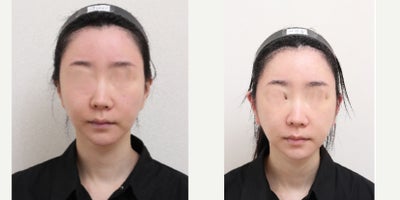 35-44 year old woman treated with AccuLift, Liposuction - 38 Years old female patientChief Complain: Face assymetry, bukly faceTreatment Plan: ACCU facial liposuctionOutcome: Smooth face line, less visible asymmetry, balanced face shape