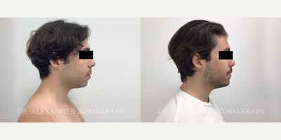 25 year old man treated with Chin Implant - 25 year old man treated with Chin Implant