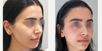 25-34 year old woman treated with Radiesse, Ellanse - This before and after result showcases a dual rejuvenation approach using Radiesse for nasolabial folds and Ellans for the under-eye area.Radiesse was applied to the nasolabial folds to provide structural support, soften deep smile lines, and improve overall facial contour. Its calcium-based formulation delivers immediate lifting while stimulating natural collagen production for long-term firmness.Ellans was used in the under-eye area to improve hollowing, fine lines, and skin quality. By stimulating collagen regeneration, Ellans helps restore a smoother, brighter, and more youthful under-eye appearance with gradual, natural-looking improvement.Together, this combination enhances facial balance, restores volume, and creates a refreshed, well-rested look.Results may vary depending on individual facial structure and skin condition.