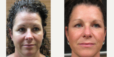 45-54 year old woman treated with BroadBand Light (BBL) - Nu-Bright PackageOur Nu-Bright package is the perfect starting point for anyone looking to address skin discoloration and moderate wrinkles. Specifically designed to target sun spots, redness, blotches, freckles, as well as common concerns like 11 lines, crows feet, bunny lines on the nose, and even faded lips, this package offers a comprehensive solution for a refreshed appearance.Whats Included:Two Sessions of BBL (BroadBand Light): These sessions work to correct pigmentation issues, reduce redness, and even out your skin tone, giving you a brighter, more uniform complexion.One Session of Botox/Dysport: This treatment smooths out moderate wrinkles, such as the lines between your brows, around your eyes, and on your nose, for a more youthful and relaxed look.Benefits:No Downtime: You can return to your daily activities immediately after each session, making this package convenient for those with busy schedules.The Nu-Bright package offers a targeted, effective approach to revitalizing your skin and smoothing out wrinkles, helping you achieve a naturally radiant and youthful appearance without the need for invasive procedures.