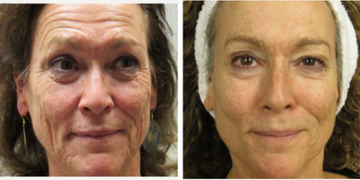 55-64 year old woman treated with Liquid Facelift - Luminous You Total RejuvenationThe Luminous You Total Rejuvenation package is our most comprehensive and luxurious facial rejuvenation offering. This premier package is meticulously designed to address a wide range of skin concerns, including discoloration, fine lines, wrinkles, loss of facial volume, and sagging or baggy skin. We also include top-tier skincare products to enhance, protect, and prolong your results, ensuring your skin remains radiant and youthful for the long term.Whats Included: BBL Sessions (BroadBand Light): As needed to correct pigmentation issues, reduce redness, and even out skin tone, providing a brighter, more uniform complexion. Two (2) Vials of Sculptra: This injectable treatment stimulates your bodys natural collagen production, restoring lost volume, improving skin texture, and providing a subtle, yet long-lasting lift to your face. Fotona 4D Sessions (as needed): This advanced laser treatment tightens and revitalizes the skin both externally and internally. It addresses sagging skin, smooths wrinkles, and enhances overall skin tone and texture for a more youthful appearance. Botox or Dysport (as needed): Target specific areas to smooth out fine lines and wrinkles, such as crows feet, forehead lines, and frown lines, resulting in a refreshed and relaxed look. Skin Care Product Base Package: A curated selection of top-of-the-line skincare products designed to complement your treatments, protect your skin, and extend the longevity of your results.Visit Schedule: Every 2-4 weeks for 3-4 months: This structured schedule ensures that your treatments are spaced optimally for maximum effectiveness, allowing your skin to heal and rejuvenate between sessions.This comprehensive package offers a holistic approach to facial rejuvenation, combining state-of-the-art treatments with high-quality skincare to achieve dramatic, long-lasting results. Whether you're looking to correct specific issues or simply want to maintain a youthful glow, the Luminous You Total Rejuvenation package provides everything you need to look and feel your absolute best.