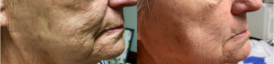 65-74 year old woman treated with Lux 1540 - Patient treated with Lux 1540 Laser for skin resurfacing. Pictures are post 6 weeks after 3 treatments.