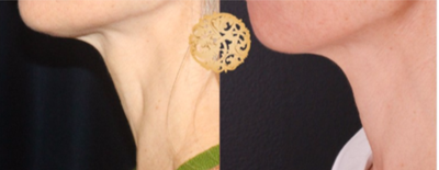 45-54 year old woman treated with Pelleve - Pelleve can be used to tighten the neck and reduce wrinkles as well.