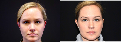 25-34 year old woman treated with Scar Removal - 28 year old female received a scar revision; photos depict the patient's results 7 months post-op.