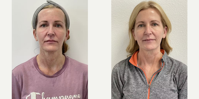 Woman treated with Morpheus8 - Woman treated with Morpheus8