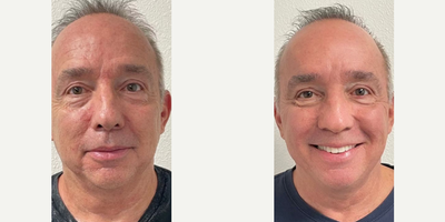 Man treated with Halo Laser - Man treated with Halo Laser