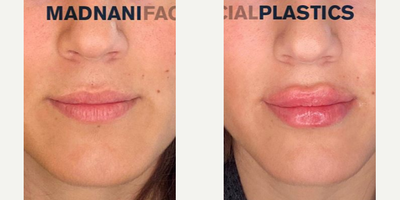 Woman treated with Volbella - Woman treated with Volbella