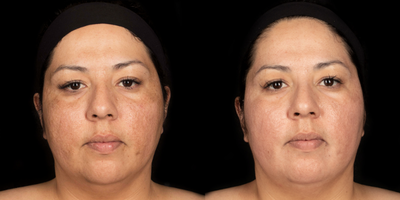 Woman in her 30's treated with Cosmelan - Woman in her 30's treated with Cosmelan, 2 weeks post-op