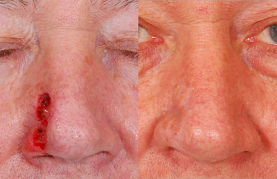 Nasal Reconstruction - 
	Before and after reconstruction of nasal defect following removal of skin cancer.
