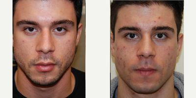 23 yr. old man treated with Silikon 1000, an off-label filler for permanent non-surgical rhinoplasty - These photos demonstrate non-surgical rhinoplasty results after two treatments with Silikon-1000, an off-label filler for permanent results. You can see a straighter nasal appearance along with improvement of the appearance of a small profile bump.