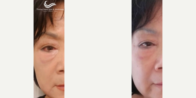Woman treated with Microneedling - Eliminate those pesky undereye bags with our new treatment, Agnes RF. The precision microneedling and the delivery of the concentrated radiofrequency stimulates fibroblasts which generate collagen and produce results that can be similar to a face or neck or eyelift.