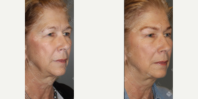 Woman treated with Eyelid Surgery - My patient - pictured here - is a perfect example of the subtle results of the impactful transformation a brow lift paired with eyelid surgery can make in reducing the signs of aging. Unfortunately, as we all rely so much on our eyes and eyebrows to express emotions, the delicate skin in these areas can begin to wrinkle and sag sooner than your other facial features, which is what this patient had concerns about. She wanted to conservatively raise her eyebrows to ensure a natural result; look at how the outer portion of her eyebrow is raised in the AFTER photo and as a result, we can see more of her upper eyelid For patients wanting a refreshed look, a brow lift or upper/lower eyelid lift may be procedures to consider, as they remove excess and drooping skin, leading to a more alert and youthful appearance.
