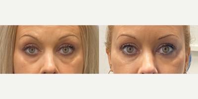 35-44 year old woman treated with Restylane - Dr. Hamori treated this patient for her concerns of shadowing in the under eyes with Tear Trough and Cheek filler