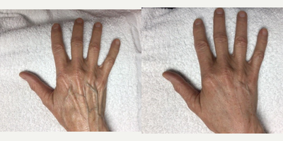 65-74 year old woman treated with Hand Rejuvenation - Patient had a hand rejuvenation treatment with a mixture of HA filler and PRP for immediate volume and long lasting collagen stimulation.