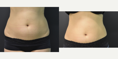 35-44 year old woman treated with UltraShape Power - Ultrashape Power