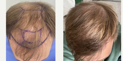 25-34 year old man treated with DHI Hair Transplant - 4465 FU greft ,DHI (Direct Hair Implantation)