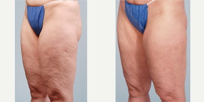 55-64 year old man treated with Cellulaze - Cellulaze