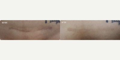 Woman treated with Laser Scar Removal - Scars are not forever!