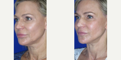 Woman treated with Nonsurgical Facelift, Nonsurgical Neck Lift - This beautiful patient came to us seeking facial rejuvenation to reverse signs of aging. We performed a FaceologyLIFT which significantly lifted her neckline, tightened her skin, and redefined her jawline.This procedure is done under local anesthesia, with a small incision that is hidden along the hairline and margins of the ear, allowing a rapid and easy recovery.