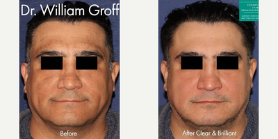 Man treated with Clear and Brilliant - Man treated with Clear and Brilliant