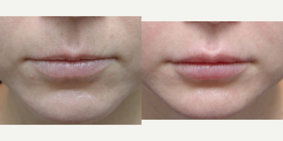 35-44 year old woman treated with Injectable Fillers - 38 year old female injected with 1ml of Juvederm Ultra XC to upper and lower lip for lip augmentation. This procedure took 30 minutes at the Med Spa. Topical anesthesia was used prior to injection.