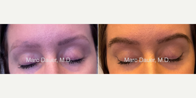 Woman treated with Eyebrow Transplant - Woman treated with Eyebrow Transplant