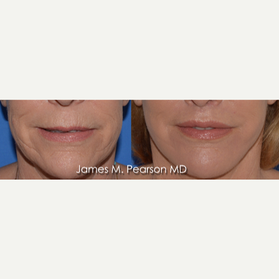 55-64 year old woman treated with Lip Lift - Patient underwent perioral rejuvenation procedures with Dr. James Pearson including Lip lift, Lip Augmentation with implant (4 mm upper lip), Dermabrasion around the mouth.