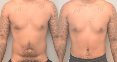 23 year old man treated with Male Tummy Tuck - 23 year old man treated with Male Tummy Tuck