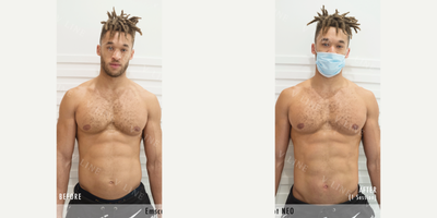 35-44 year old man treated with Emsculpt - 35-44 Year Old Man Treated With Emsculpt.