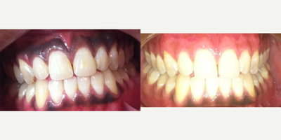 18-24 year old woman treated with Gingival Peeling  - 23 years old woman treated with a gingival peeling on 1 day post-op