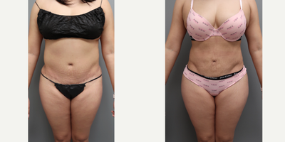 35-44 year old woman treated with Brazilian Butt Lift - This patient had a tummy tuck with lipo before she came to us. She still had a decent amount of fat around her midsection as well as some areas of asymmetry. We did a high volume lipo 360 and fat grafting to her butt and hips to help improve her proportions all around. She is 3 months out with some swelling but looking great already.