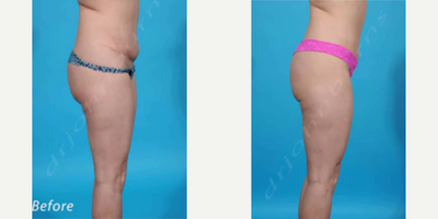 Woman treated with Liposuction Revision  - Woman treated with Liposuction Revisionto flanks as well as Tummy Tuck Revisionwithlowered incision below panty line and Belly ButtonRevision.
