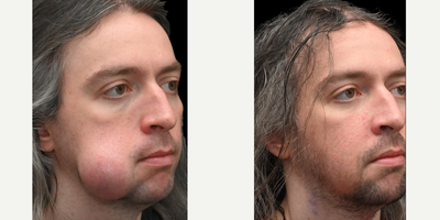 35-44 year old man treated with Lipoma Removal - This patient had a facial lesion for several years before coming to see us. We were able to remove this lesion entirely through an incision in the mouth (without any external incisions)! Here are his photos at only 1 week after lesion removal.