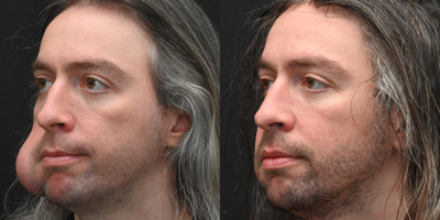 35-44 year old man treated with Lipoma Removal - This patient had a facial lesion for several years before coming to see us. We were able to remove this lesion entirely through an incision in the mouth (without any external incisions)! Here are his photos at only 1 week after lesion removal.