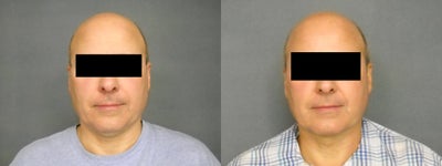 Age: 53, Height: 57, Weight: 155lbs. - 
	Liposuction.
