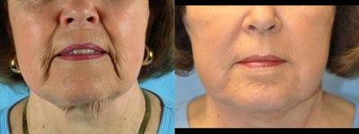 77 Year Old Treated for Unacceptable Cosmetic Appearance of Face - 
	Procedure: CO2 Laser Treatment
