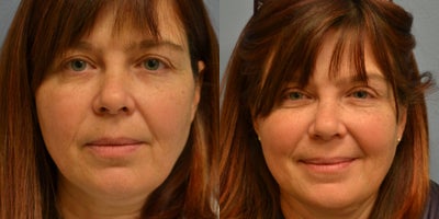 48 year old woman treated with Voluma - 48 year old female received Voluma XC to enhance contour and create a more youthful profile.
