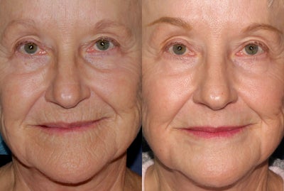 67 year old woman treated to wrinkles around mouth, texture issues with Fraxel repair and other lasers - I treated this patient one time with a combination of Fraxel, Ultrapulse Encore CO2, and Erbium lasers. Note the reduction of lines around the mouth and textural improvement.