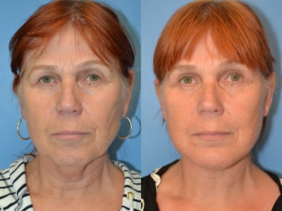 58 year-old female presenting with age-related facial changes - 
	58 year-old female underwent endoscopic browlift, upper and transconjunctival lower blepharoplasties, fat grafts to tear troughs, and facelift with chin augmentation to address age-related facial changes.
