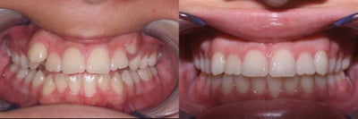 15 Year Old Female Orthodontics Without Extractions - 
	This 15 year old girl was self-conscious because of extreme crowding and her teeth erupting looked like fangs. Treatment was completed in less than a year without extracting bicuspids
