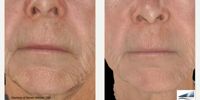 Infini RF - Photo provided courtesy of Lutronic, performed by Steven F. Weiner, MD