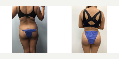 45-54 year old woman treated with Brazilian Butt Lift - The patient underwent Liposuction 360 and BBL