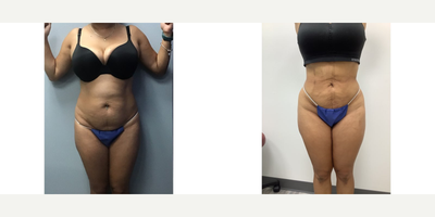 45-54 year old woman treated with Brazilian Butt Lift - The patient underwent Liposuction 360 and BBL